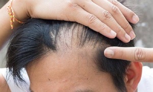 ریزش مو بعد از کاشت طبیعیه؟